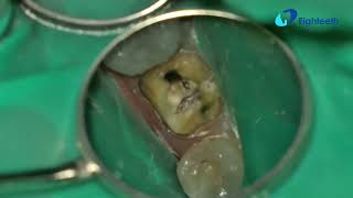 POV clinical video of THIS calcified tooth 19 from start to finish. Go to flexivodental.com 