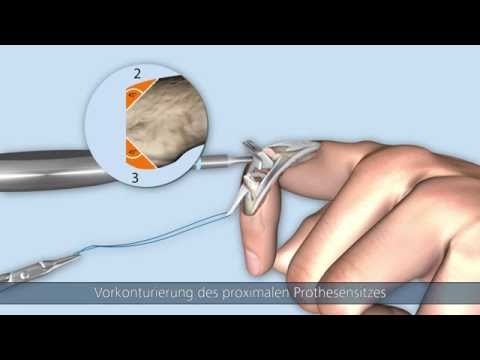 CapFlex PIP – Endoprothetische Versorgung des proximalen Interphalangealgelenks (dorsaler Zugang)