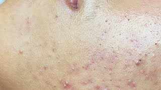 Full face of blackheads – no area is safe! #611 P2