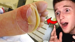 Guy peels his foot and it is SO SATISFYING!