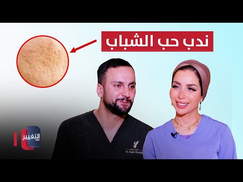 شاهد بالفيديو.. علاج ندوب حب الشباب العميقة بجلسة واحدة | الدكتور مجدي الحديدي