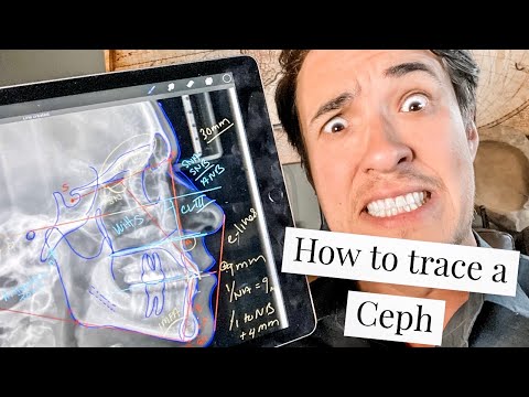 How to trace a Lateral Ceph in orthodontics