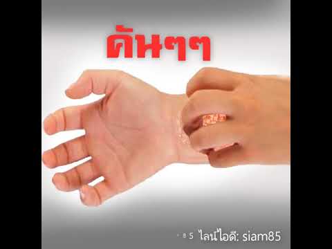 สิ่งที่วิตามินสามารถสับในโรคสะเก็ดเงิน ครีม Teva โรคสะเก็ดเงิน