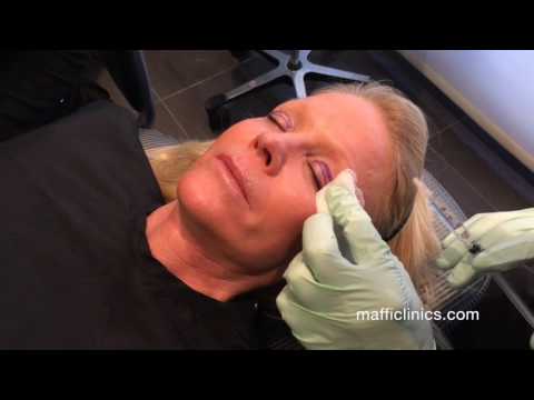 Maffi Clinics: Upper Eyelid Surgery (Blepharoplasty)