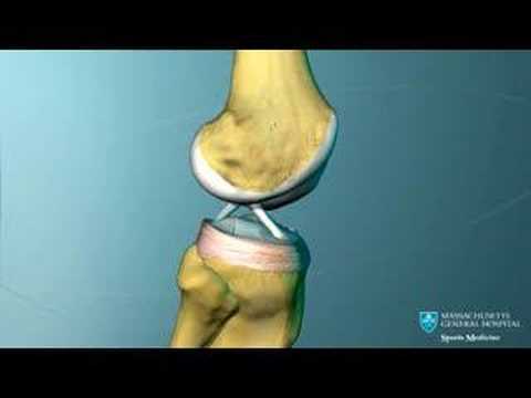 Medicament pentru introducerea în articulația genunchiului