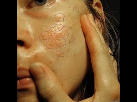 Яблочный уксус для отбеливание кожи Пилинг от пигментных пятен форум