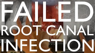 Failed Root Canal Case: Infection, Cyst, Extraction & Prep for Dental Implants
