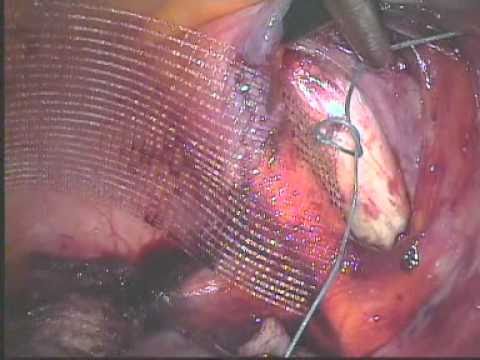 Pectopexy for vault prolapse - Urogynaecology & Laparoscopy Clinic