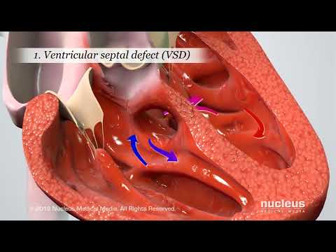 Blue Baby Heart Defect: Tetralogy of Fallot