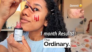 The Ordinary Peeling Solution before and after Review! (12 weeks)