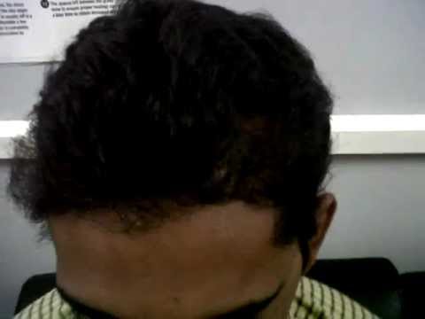 FUE Hair Transplantation after 7 months