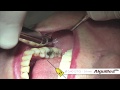 Quicksleeper 5 - Intraosseous injection in the retromolar trigonum