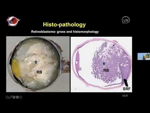 Retinoblastoma: Current Concepts of Management by Oncologist Dr P. Vijay Anand Reddy.