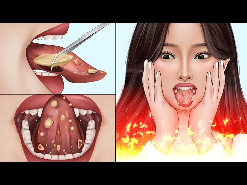 , title : 'ASMR Canker sores cause of mouth ulcer treatment | Tonsil stone removal animation'