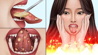 ASMR Canker sores cause of mouth ulcer treatment | Tonsil stone removal animation