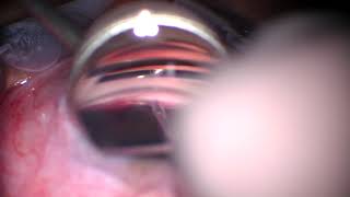 Download Lagu Kosko GATT (gonioscopy-assisted transluminal trabeculotomy) for JOAG (juvenile open angle glaucoma) Thumbnail
