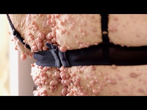 La neurofibromatose de Rachel - S.O.S Dermato