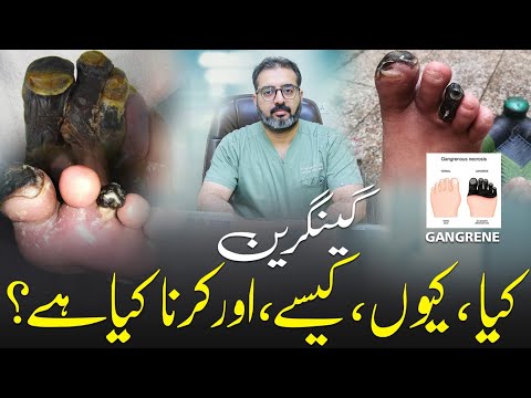 Understanding Gangrene | Types, Causes & Early Warning Signs