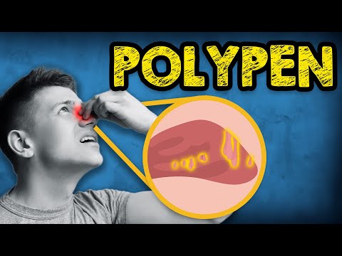 Children and adults affected: Nasal polyps - The vicious cycle of mouth breathing