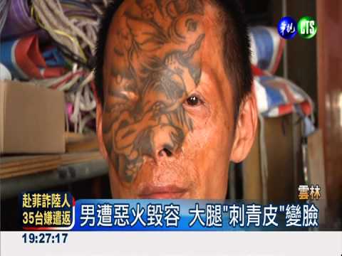 男遭惡火毀容 "刺青皮"變臉救命