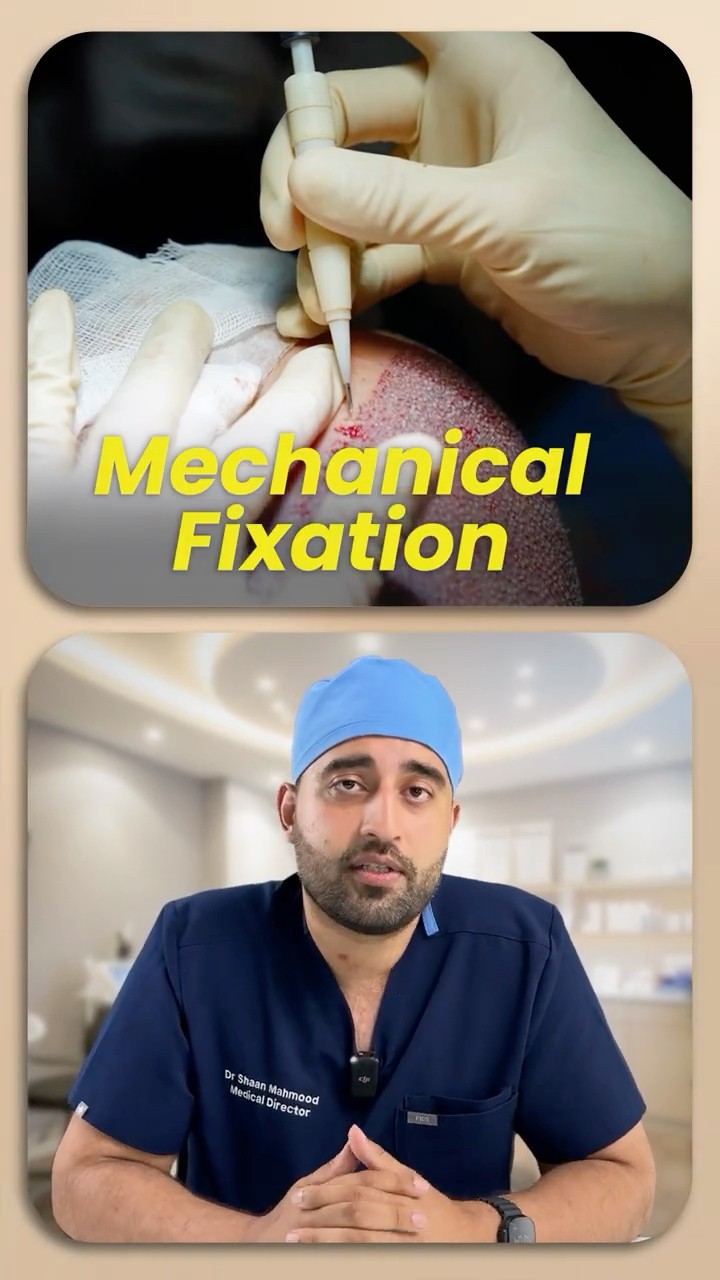 How Long Does It Take for Hair Grafts to Anchor After a Hair Transplant?