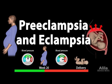 Preeclampsia and Eclampsia, Animation