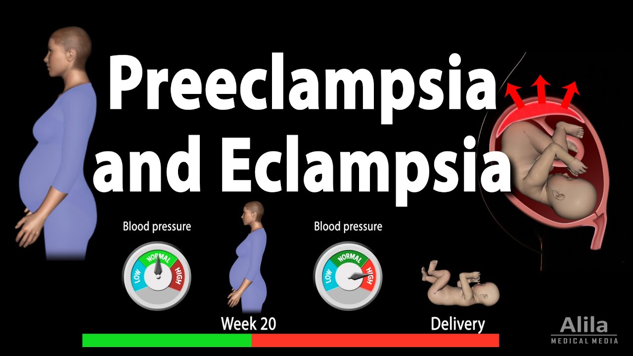 Preeclampsia and Eclampsia, Animation