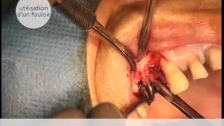 COMBLEMENT SIMPLE D'UNE ALVEOLE