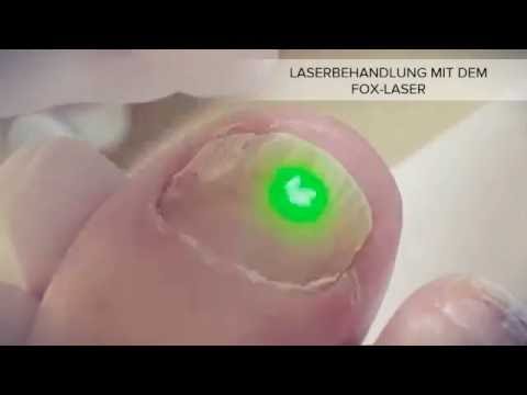 Der Nagel auf dem Bein potschernel, wie zu behandeln Wie den Nagelzwang der Chirurg behandelt