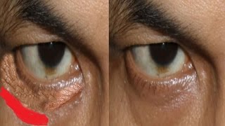 Get rid of eye’s wrinkles naturally