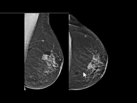 Aspectos mamográfico e ultrassonográfico da injeção de ozônio na mama em paciente com câcer de mama.