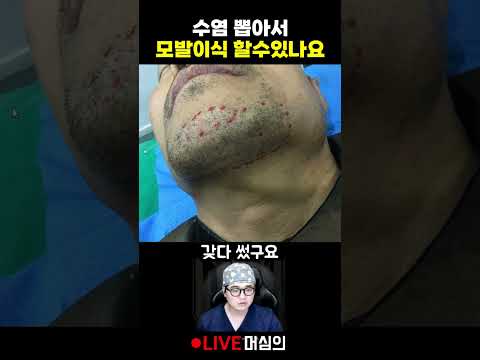 턱수염 뽑아서 모발이식