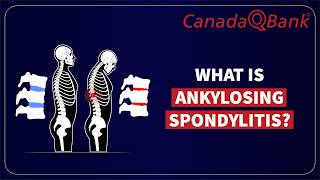 Ankylosing Spondylitis
