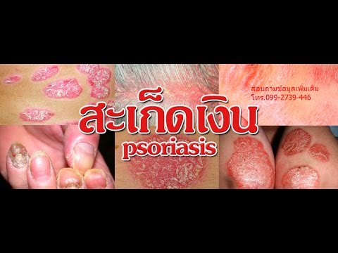 โรคสะเก็ดเงินแชมพู ducray โรคสะเก็ดเงินอายุรเวทอาหาร