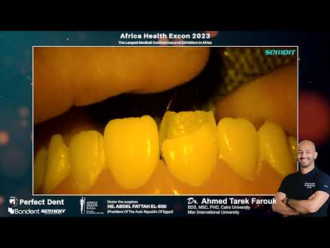 Dr. A. Tarek Class IV Composite Demo | Semorr 4K PRO | Perfect Dent