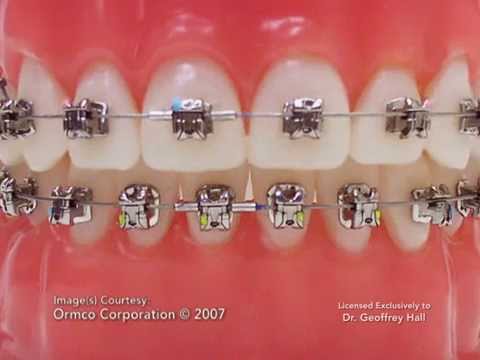 Self Ligating Brackets At Best Price In India