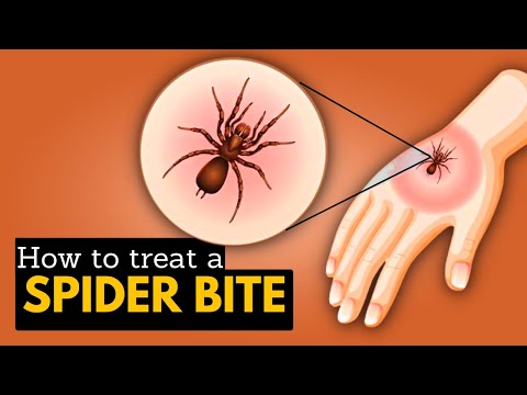 How to Treat A Spider's Bite?