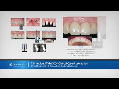 Zimmer Biomet T3® Implants*