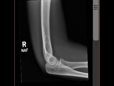 Racing With a Broken Forearm - JCM Criterium Series 2 2022 Men Junior