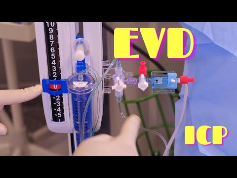 External Ventricular Drainage (EVD) and ICP Monitoring