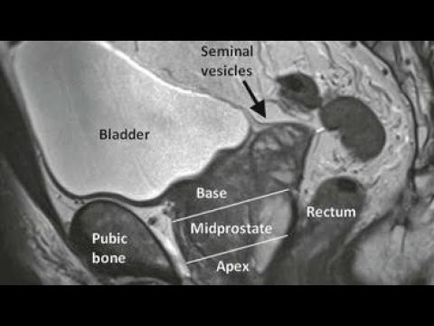 Prostatitis és otthoni kezelési módok