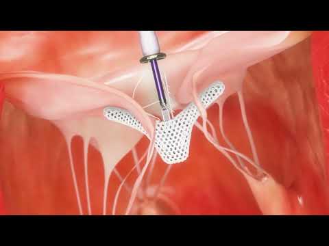 Triclip™ Transcatheter Tricuspid Valve Repair System