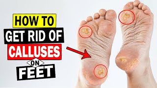 How to Remove Calluses on Feet at Home || Home Remedies for Calluses on Feet Removal