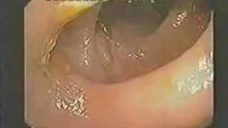 Colon Hydrotherapy & Parasite Elimination