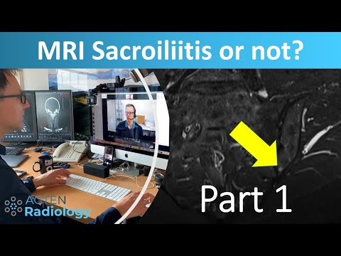 Sacroiliitis or not? (with Prof. Hermann)