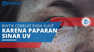 Mengenal Freckles, Bintik Cokelat pada Kulit Muncul akibat Melanin Berlebih dan Paparan Sinar UV