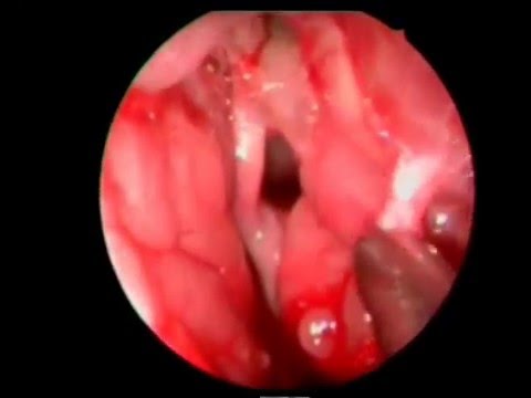 Esophageal cancer caused by hpv