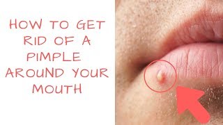 How to get rid of PIMPLES Around your mouth | PrettyBoyFloyd 🌹