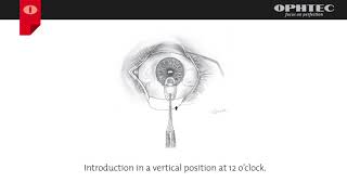 Standard Implantation Technique for Artisan (P)IOLs
