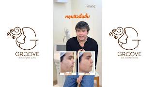 หลุมสิวเป็นปมในชีวิต